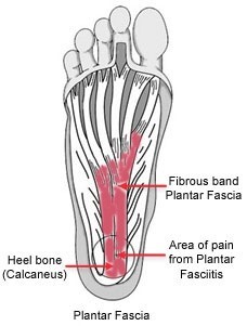 Anatomical diagram of the plantar fascia plantar fasciosis