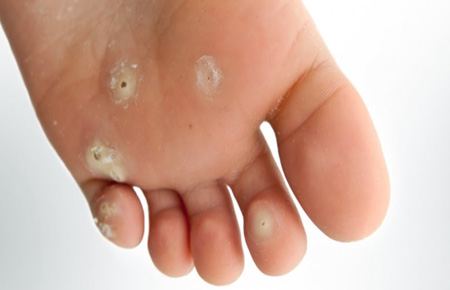 painful plantar warts