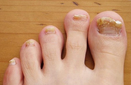 Thickened and Discoloured Toenails