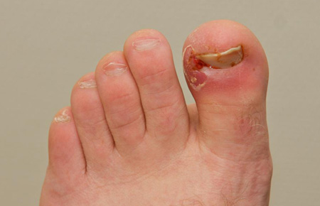 painful infected ingrown toenail