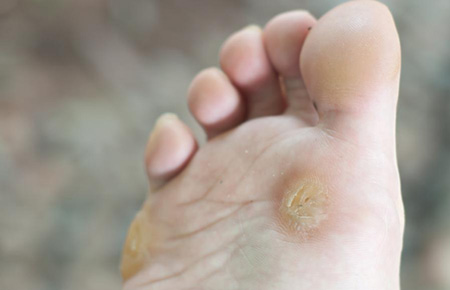 verruca pedis wart hyperkeratoses